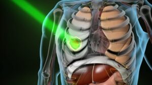 radiation therapy treatment