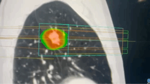 how radiation target only cancer cells 